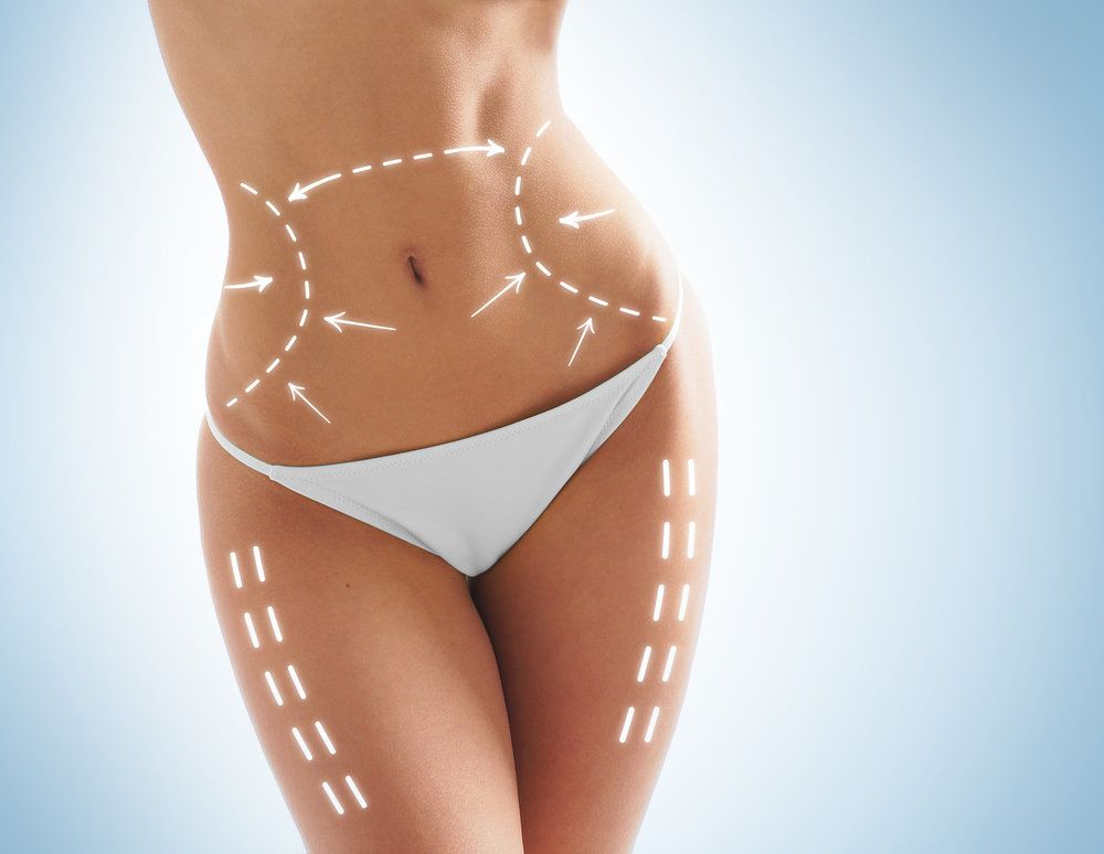 woman's lower torso noting incision sites and treatment areas