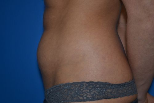 enlarged abdomen before tummy tuck