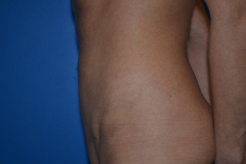 flat abdomen after tummy tuck