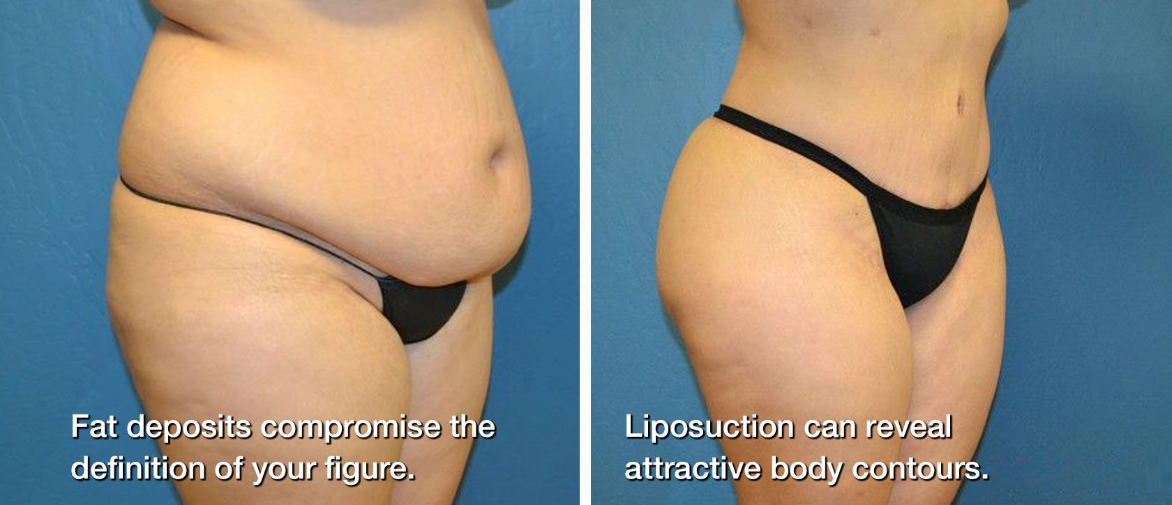 Before and after liposuction